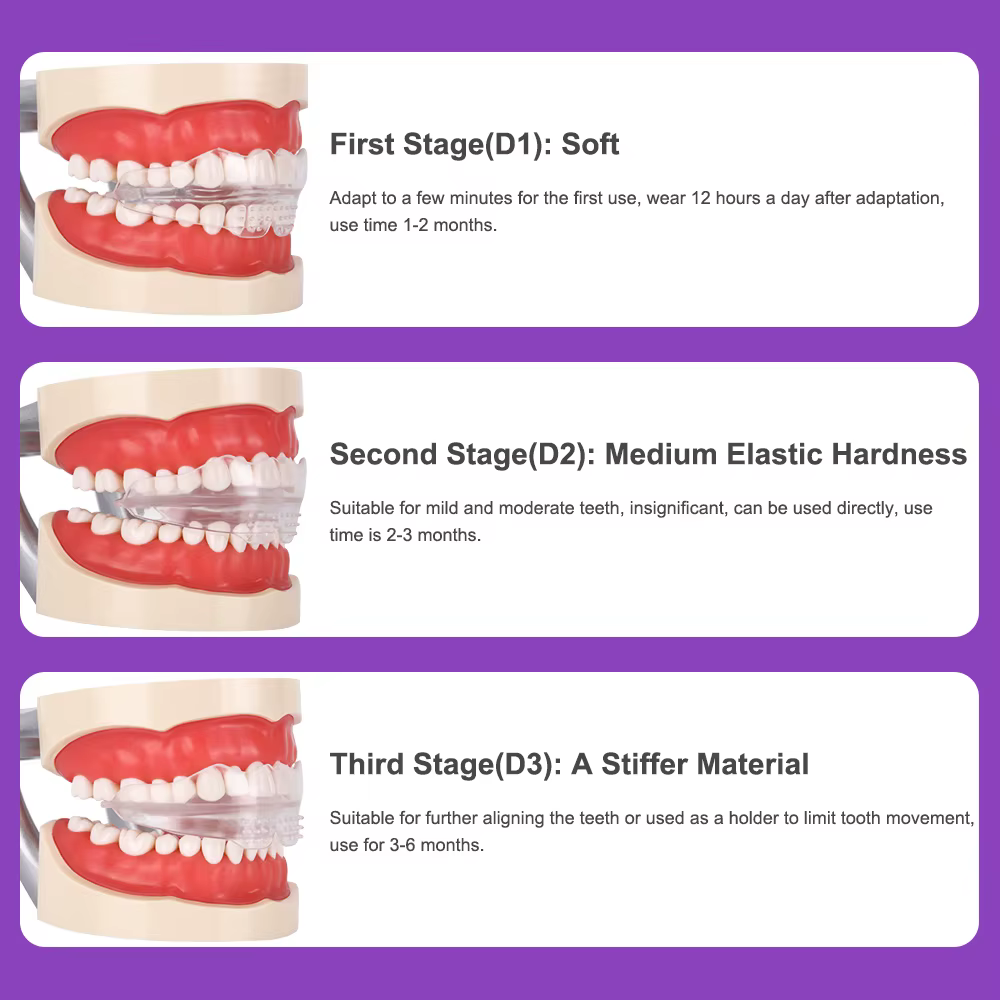 Appareil dentaire, accolades orthodontiques, entraîneur de dents, entraîneur d'alignement, embout po